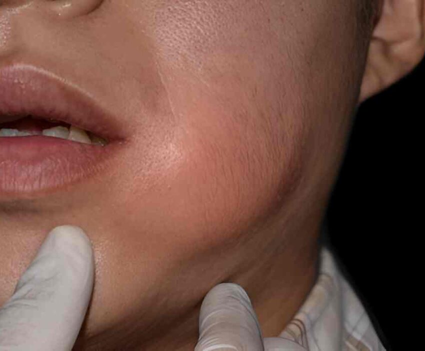 Pictures of gum boils