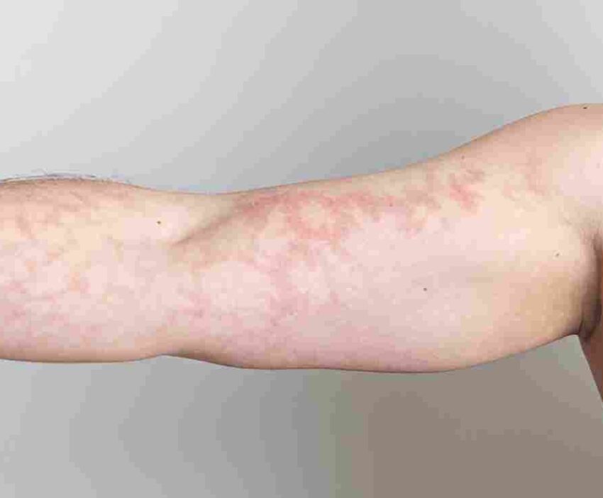 photos of mottled skin