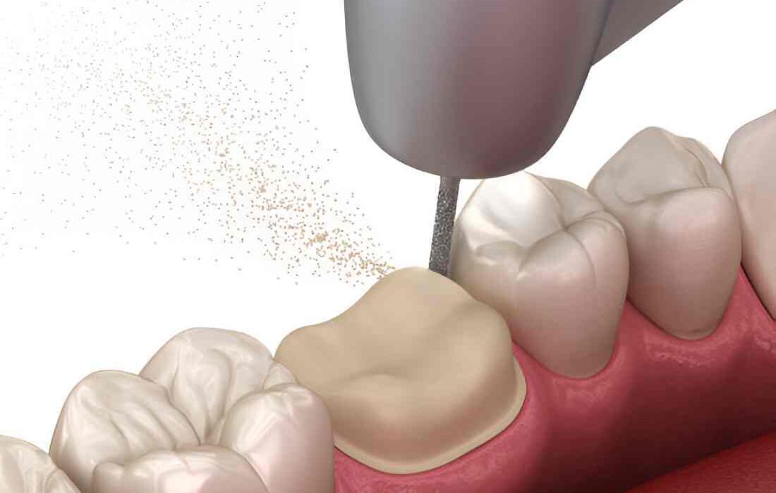 Molar Broke Off at Gum