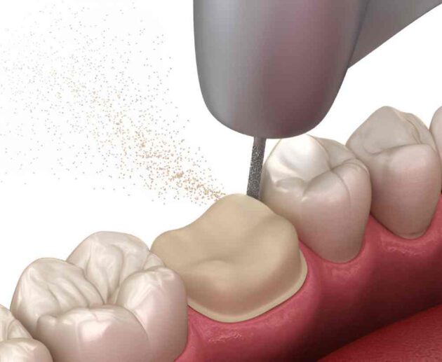 Molar Broke Off at Gum