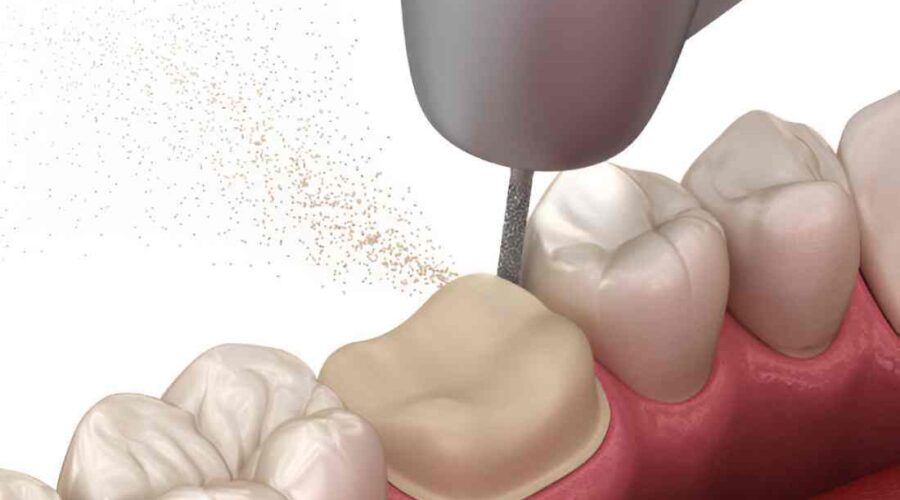 Molar Broke Off at Gum