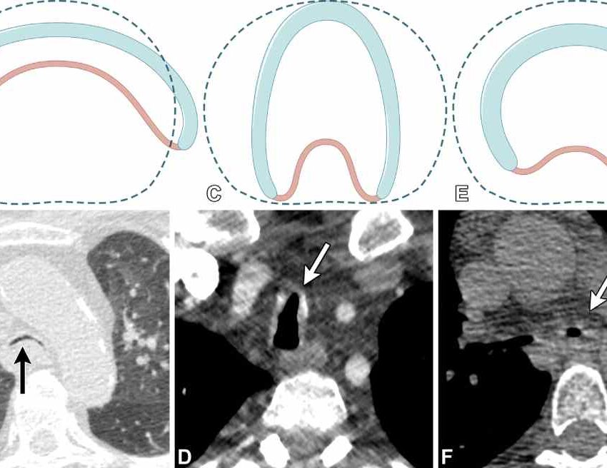 edac achalasia